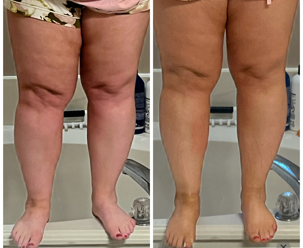Body contouring before and after (combined)